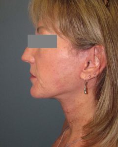 Facelift Before and After Pictures