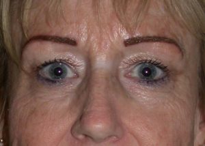 Blepharoplasty (Eyelid Lift) Before and After Pictures