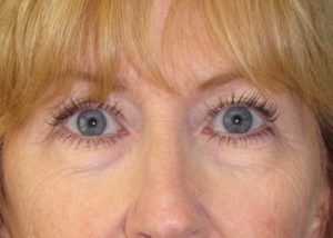 Blepharoplasty (Eyelid Lift) Before and After Pictures