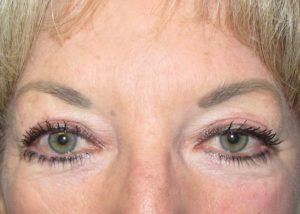 Blepharoplasty (Eyelid Lift) Before and After Pictures