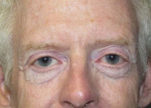 Blepharoplasty (Eyelid Lift) Before and After Pictures