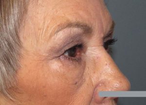 Blepharoplasty (Eyelid Lift) Before and After Pictures