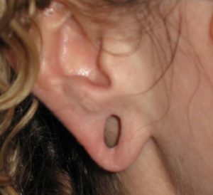 Earlobe Repair Before and After Pictures