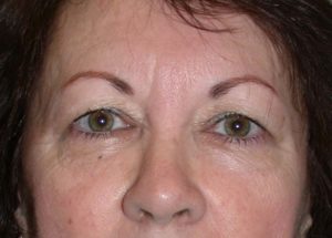 Blepharoplasty (Eyelid Lift) Before and After Pictures