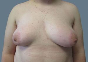 Transgender Top Surgery Before and After Pictures