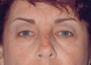 Blepharoplasty (Eyelid Lift) Before and After Pictures