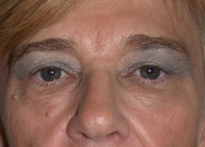 Blepharoplasty (Eyelid Lift) Before and After Pictures