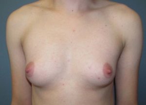 Transgender Top Surgery Before and After Pictures