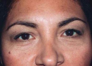 Blepharoplasty (Eyelid Lift) Before and After Pictures