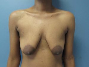 Transgender Top Surgery Before and After Pictures