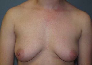 Transgender Top Surgery Before and After Pictures