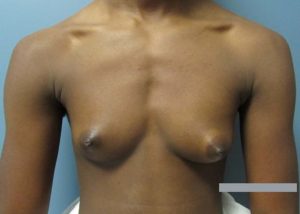 Transgender Top Surgery Before and After Pictures