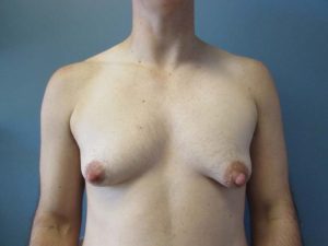 Transgender Top Surgery Before and After Pictures