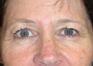 Blepharoplasty (Eyelid Lift) Before and After Pictures