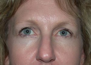 Blepharoplasty (Eyelid Lift) Before and After Pictures