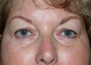 Blepharoplasty (Eyelid Lift) Before and After Pictures