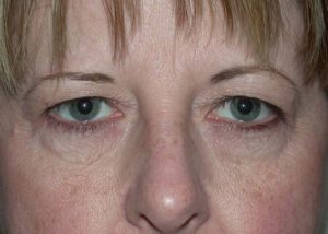 Blepharoplasty (Eyelid Lift) Before and After Pictures