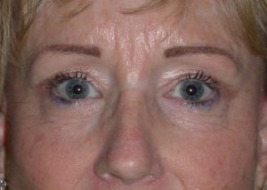 Blepharoplasty (Eyelid Lift) Before and After Pictures