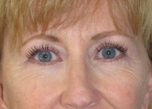 Blepharoplasty (Eyelid Lift) Before and After Pictures