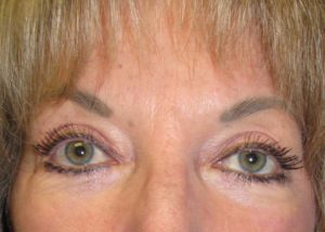 Blepharoplasty (Eyelid Lift) Before and After Pictures