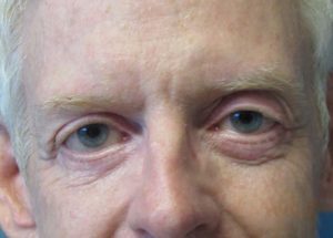 Blepharoplasty (Eyelid Lift) Before and After Pictures