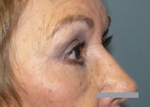 Blepharoplasty (Eyelid Lift) Before and After Pictures