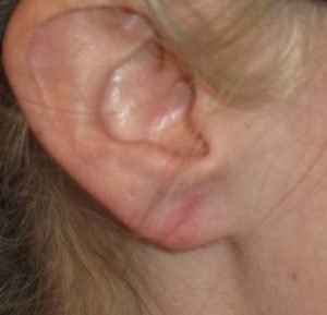 Earlobe Repair Before and After Pictures