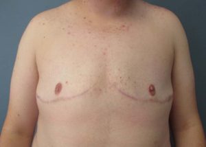 Transgender Top Surgery Before and After Pictures