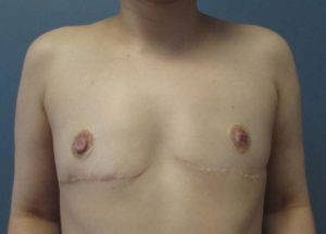 Transgender Top Surgery Before and After Pictures