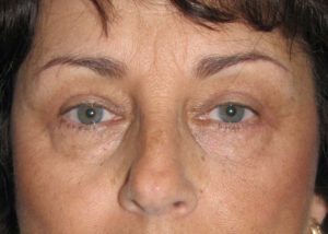 Blepharoplasty (Eyelid Lift) Before and After Pictures