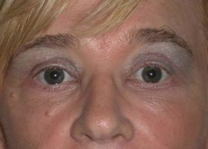 Blepharoplasty (Eyelid Lift) Before and After Pictures