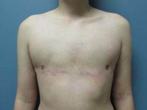 Transgender Top Surgery Before and After Pictures