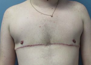 Transgender Top Surgery Before and After Pictures