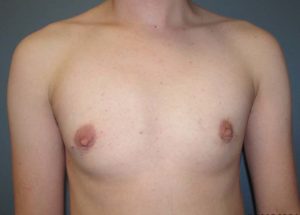 Transgender Top Surgery Before and After Pictures