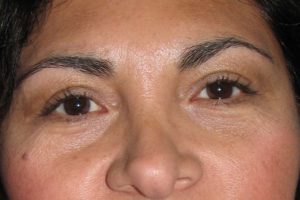 Blepharoplasty (Eyelid Lift) Before and After Pictures