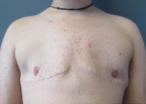 Transgender Top Surgery Before and After Pictures