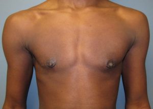 Transgender Top Surgery Before and After Pictures