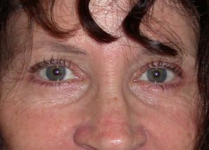 Blepharoplasty (Eyelid Lift) Before and After Pictures