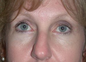 Blepharoplasty (Eyelid Lift) Before and After Pictures