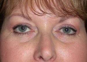 Blepharoplasty (Eyelid Lift) Before and After Pictures