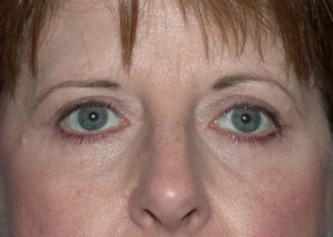 Blepharoplasty (Eyelid Lift) Before and After Pictures