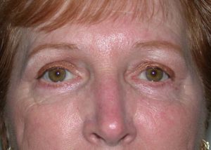 Blepharoplasty (Eyelid Lift) Before and After Pictures