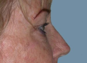 Blepharoplasty (Eyelid Lift) Before and After Pictures