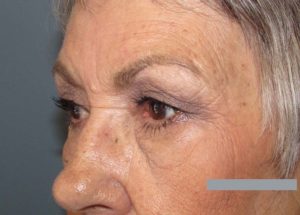 Blepharoplasty (Eyelid Lift) Before and After Pictures