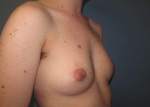 Transgender Top Surgery Before and After Pictures