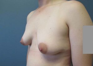 Transgender Top Surgery Before and After Pictures