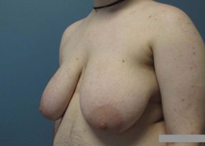 Transgender Top Surgery Before and After Pictures