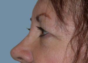 Blepharoplasty (Eyelid Lift) Before and After Pictures