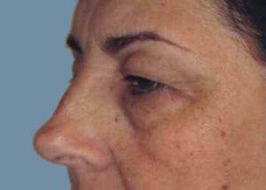 Blepharoplasty (Eyelid Lift) Before and After Pictures