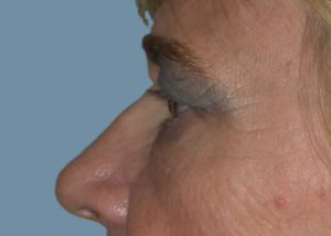 Blepharoplasty (Eyelid Lift) Before and After Pictures